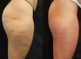 Comment lutter efficacement contre la cellulite ?