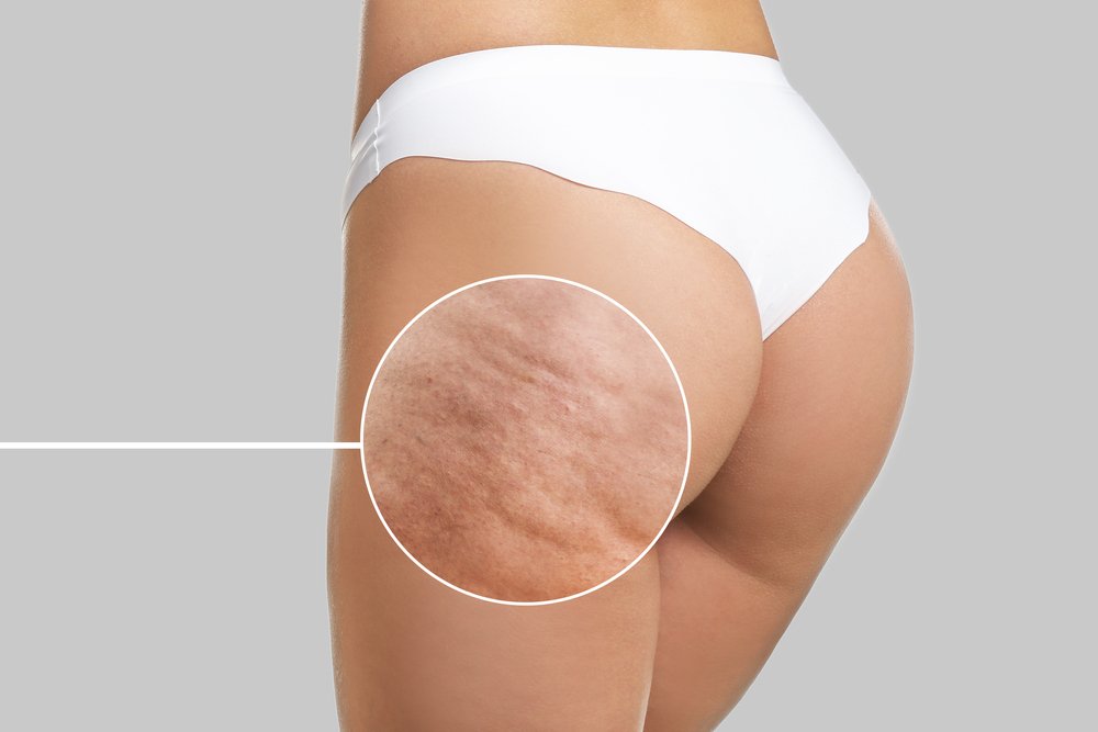 La Cellulite : Causes, Solutions et Conseils pour une Peau Plus Lisse